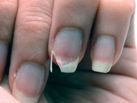 Uñas débiles o que no crecen
